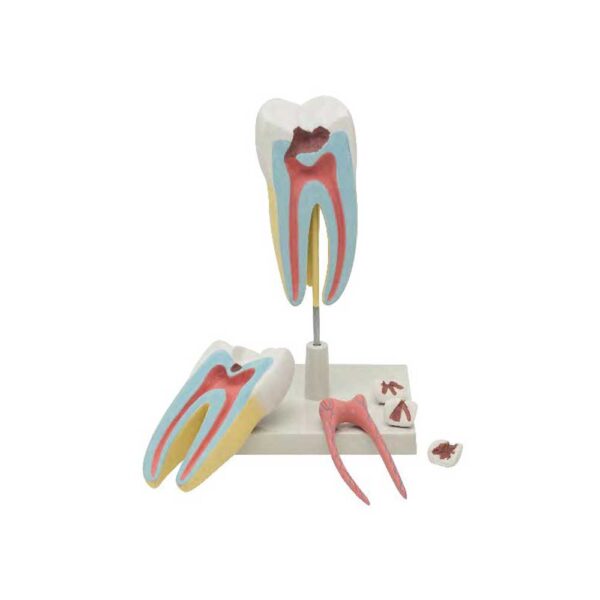 ADVANCED HUMAN TOOTH MODEL: UPPER TRIPLE ROOT MOLAR WITH CARIES